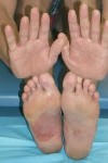 dermatite-mani-piedi